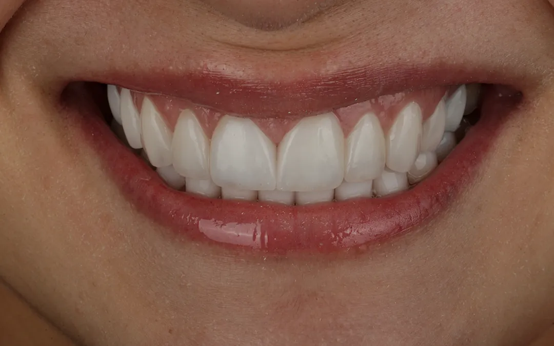 Laminados cerâmicos para diastema - depois