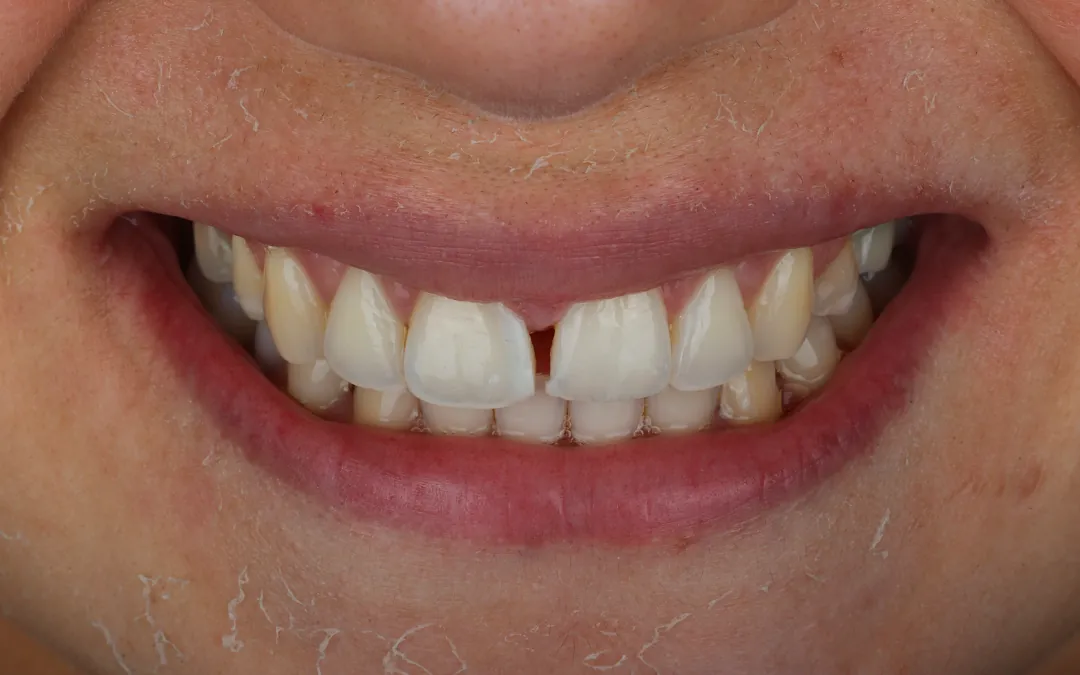 Laminados cerâmicos para diastema - antes