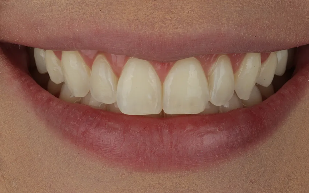 Gengivoplastia a laser - depois