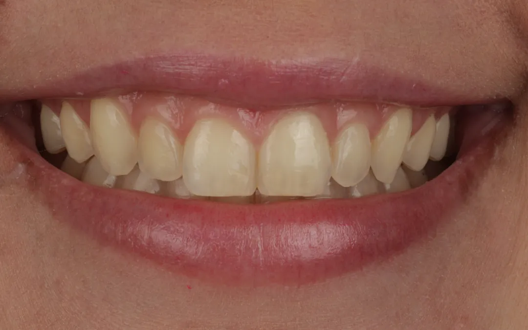 Gengivoplastia a laser - antes